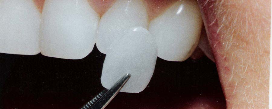 Keramicke fasete za zube - Iskustva, Cena | Dental SPA Niš